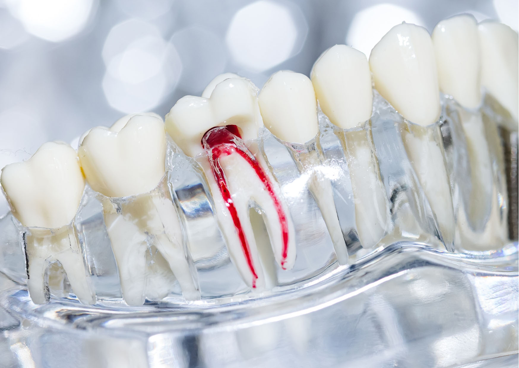 root canal treatment in liverpool