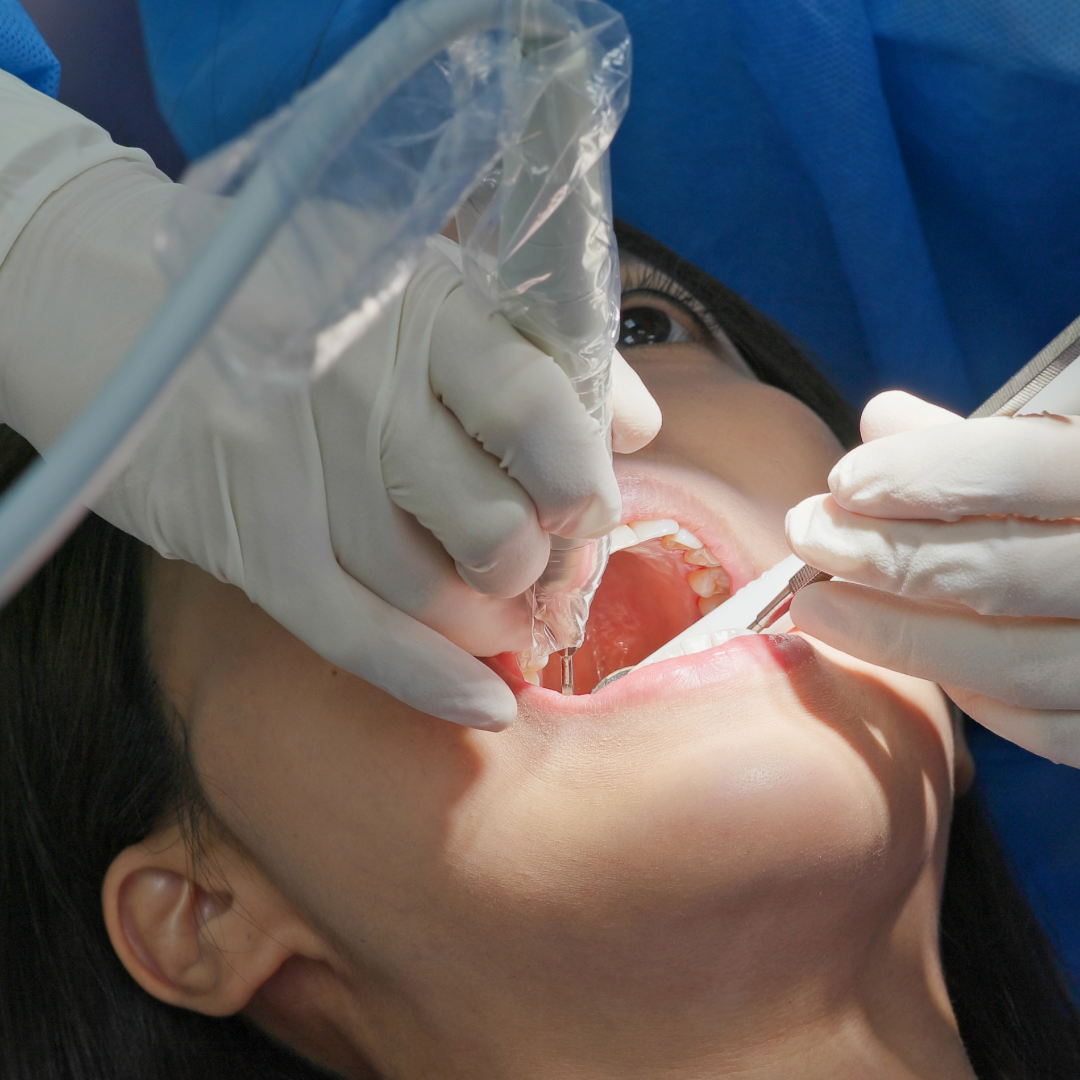 root canal specialist in liverpool